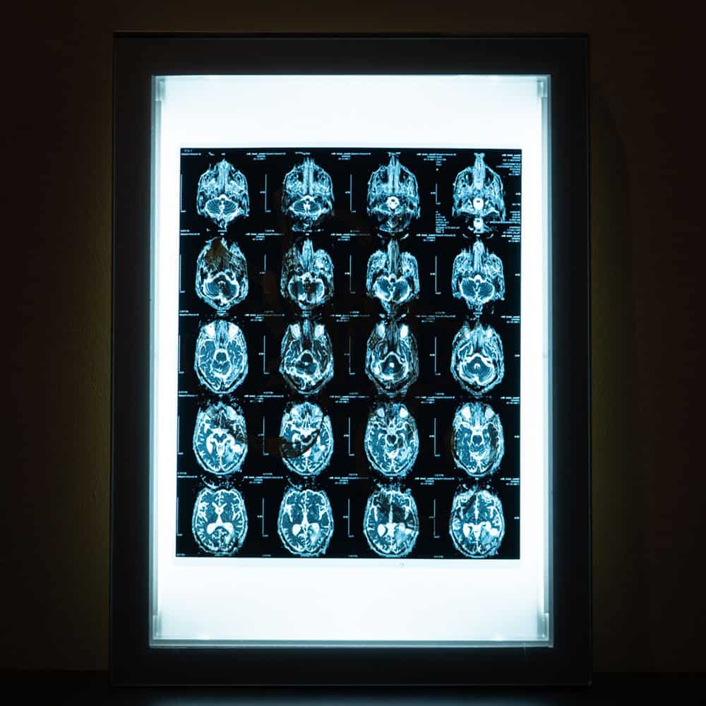 Acroe Brain Scan 1/3