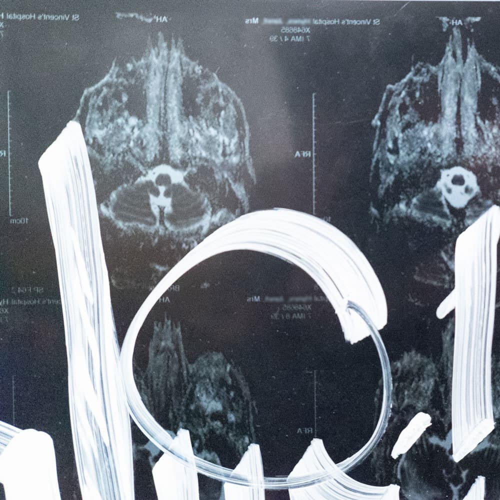 Acroe Brain Scan 1/3