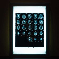Acroe Brain Scan 2/3